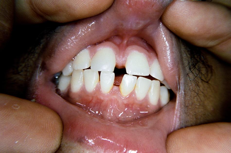 "Show me" by Deion Squires (2022). A person's mouth is stretched open with fingers, revealing their teeth. They have a gap in their top front teeth, and their bottom front teeth.